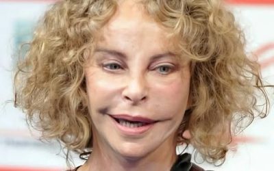 PHOTOS Avant/Après : ces stars qui ont VRAIMENT abusé de la chirurgie esthétique