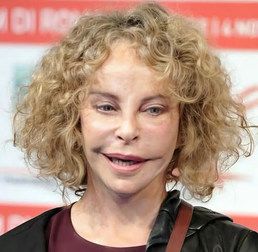 PHOTOS Avant/Après : ces stars qui ont VRAIMENT abusé de la chirurgie esthétique